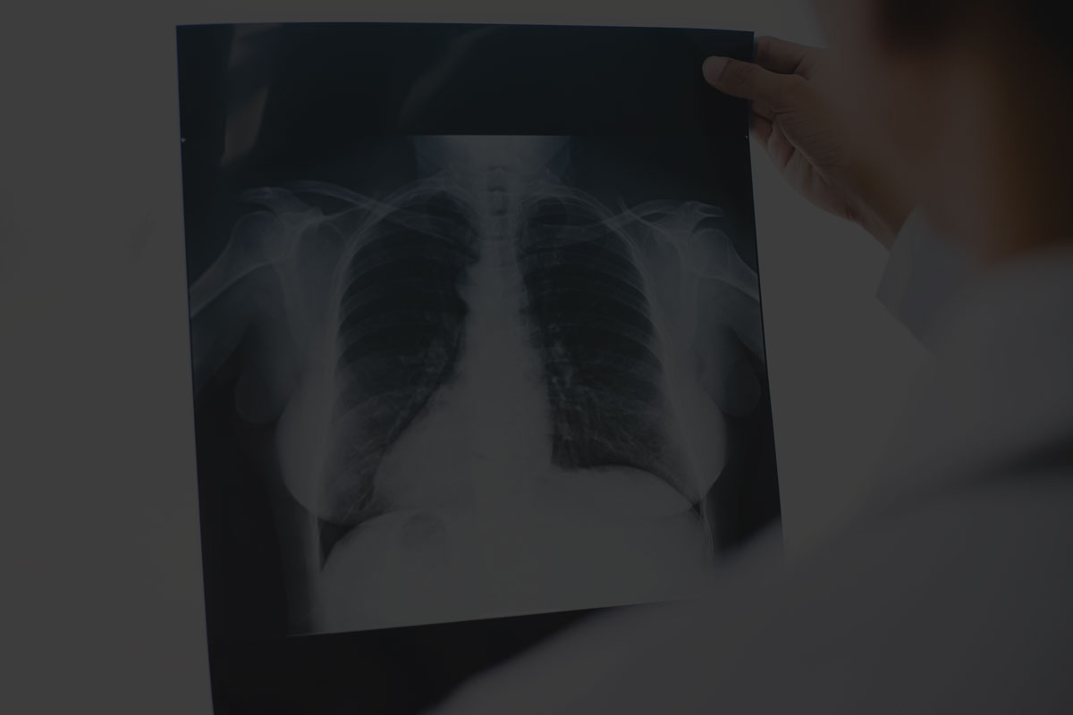 Conoce la aplicación qure.ai, inteligencia artificial para la detección de nódulos pulmonares